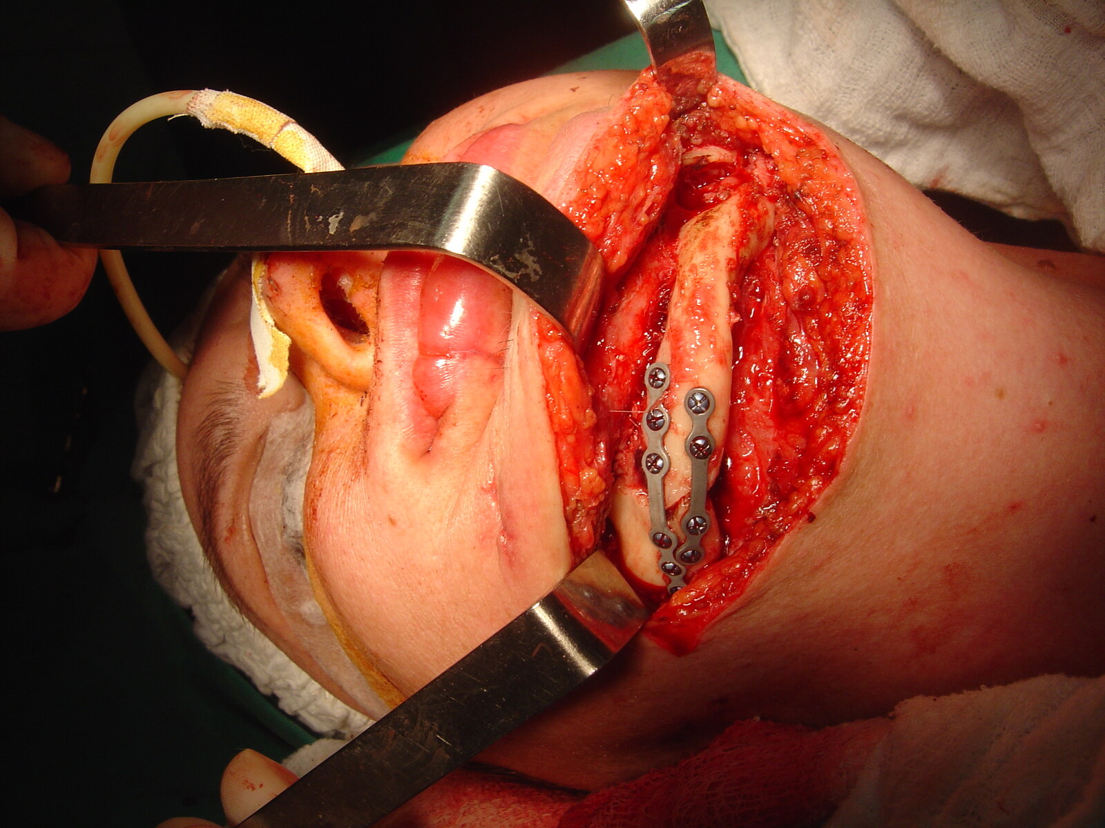 Completed rigid internal fixation of the right mandible