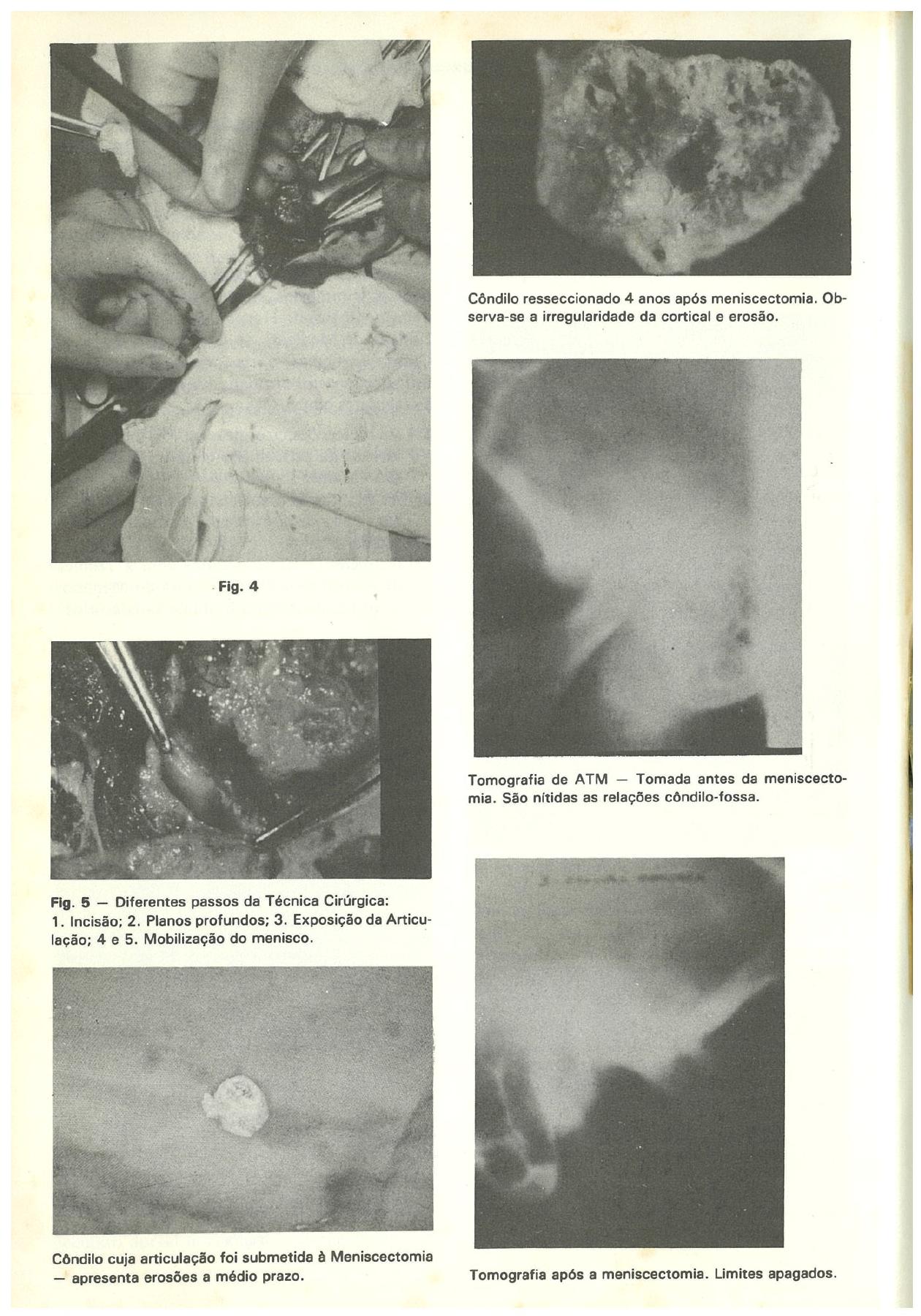 Original article plate showing surgical steps, a resected condyle and TMJ tomograms